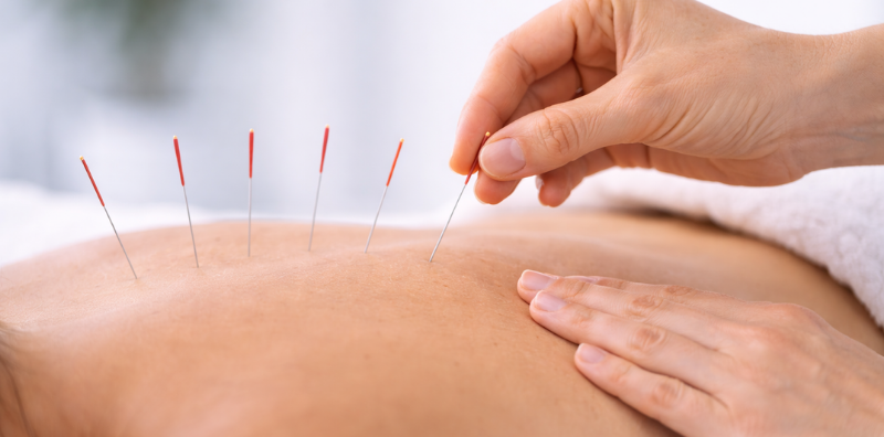 Medical Acupuncture Medical Acupuncture